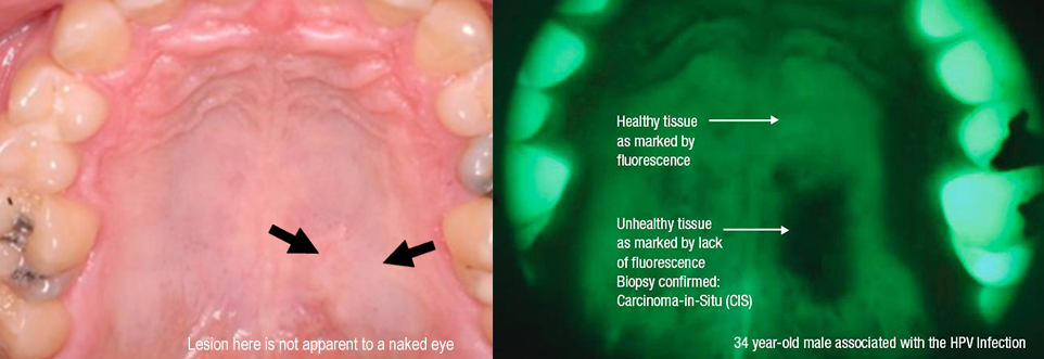 Mouth Cancer VELscope Vx